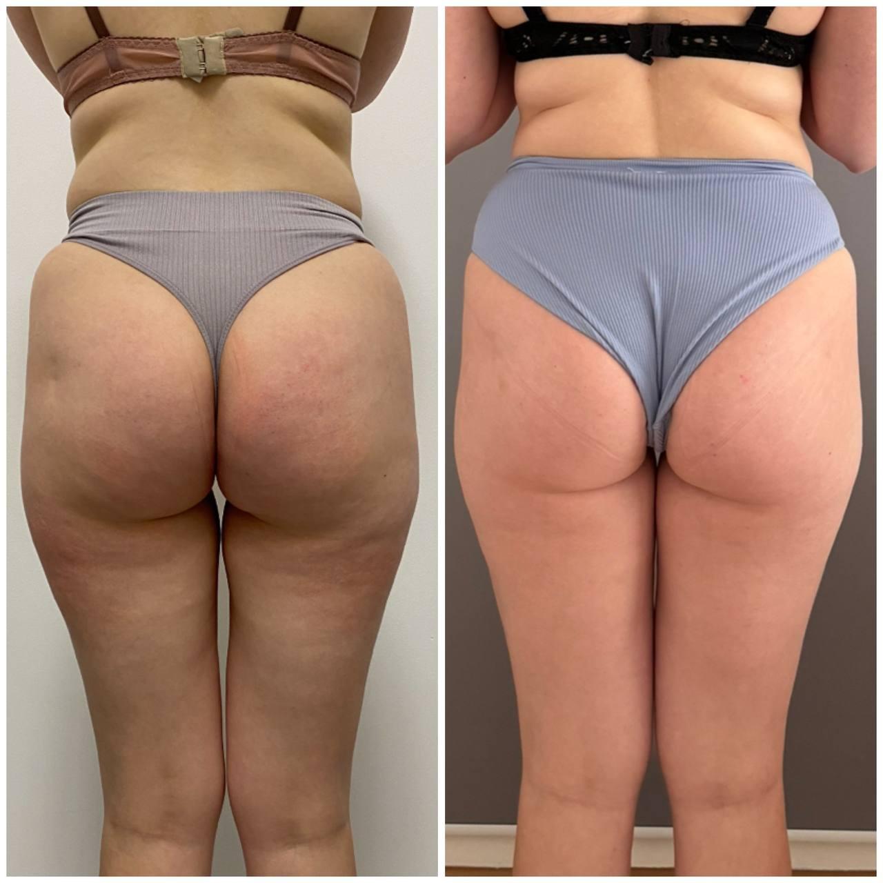 Pressotherapy treatment — After