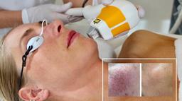Vascular Laser Treatment