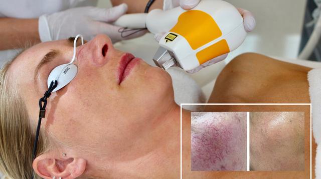 Vascular Laser Treatment